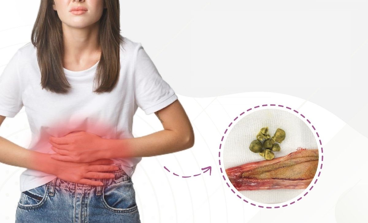 Uống cà phê giúp ngừa sỏi mật được không?