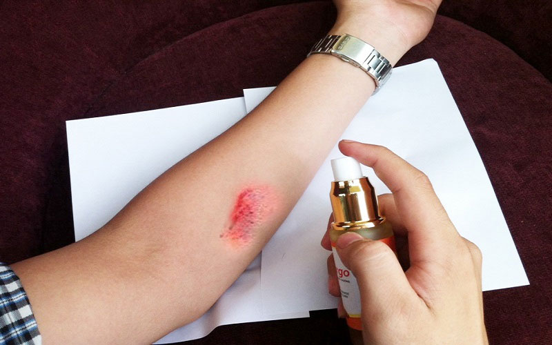 Các loại tinh dầu trị SẸO, làm mờ vết thâm nám hiệu quả